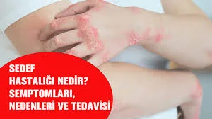 sedef hastalığı